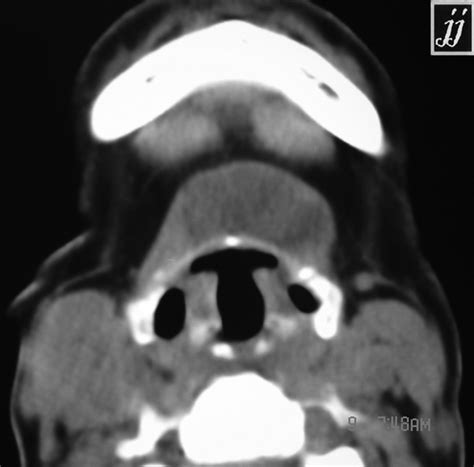 High Dome Left Jugular Bulb Radiopaedia