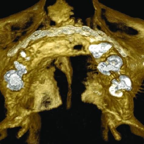 The Postsecondary Alveolar Cleft Repair As Shown In Figure 2