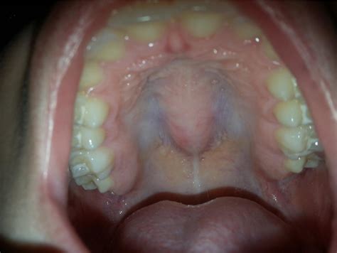 Midline Hard Palate Nontender Swelling That Was Bony Hard In