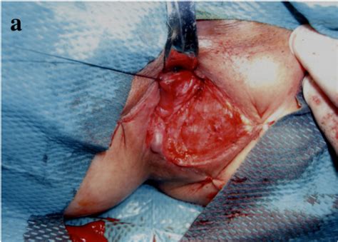 Squamous Cell Carcinoma Of The Anus Telegraph