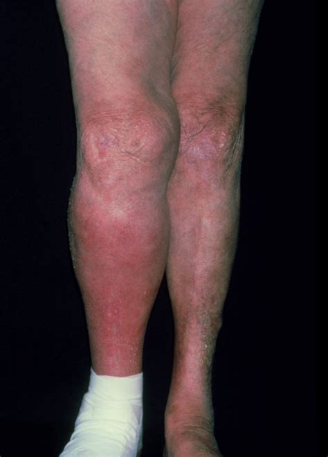 Deep Vein Thrombosis The Bmj