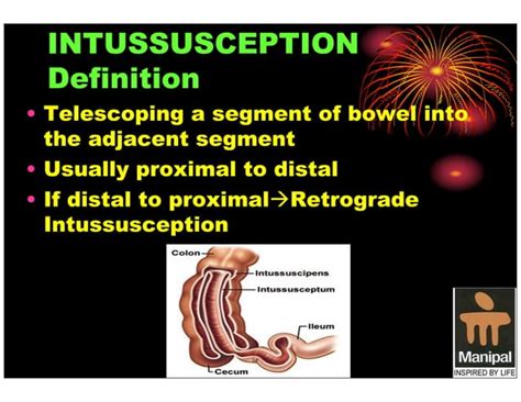 Pediatric Intussusception An Overview Ppt