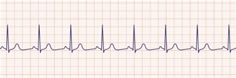 ECG Flashcards | Quizlet