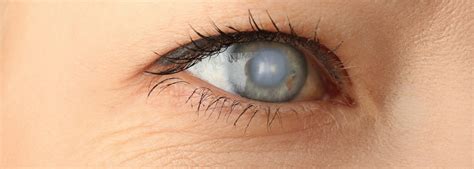 What Is Cataract Surgery With An Intraocular Lens Griffin Eye