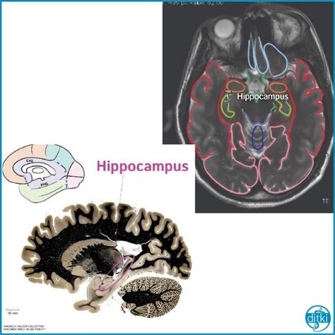 Click Through Clinical Images And Photographs Of The Hippocampus