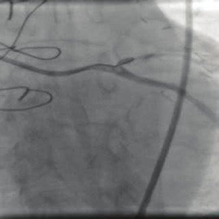 After Percutaneous Coronary Intervention (PCI) Angiography. | Download ...