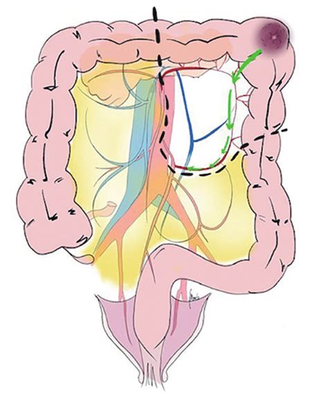 Splenic Flexure Drainage Pathways Indicated By Green Arrows A Main Download Scientific