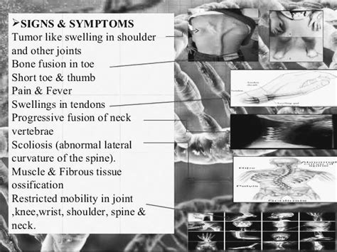Fibrodysplasia Ossificans Progressiva Or Stone Man Syndrome Pt Master