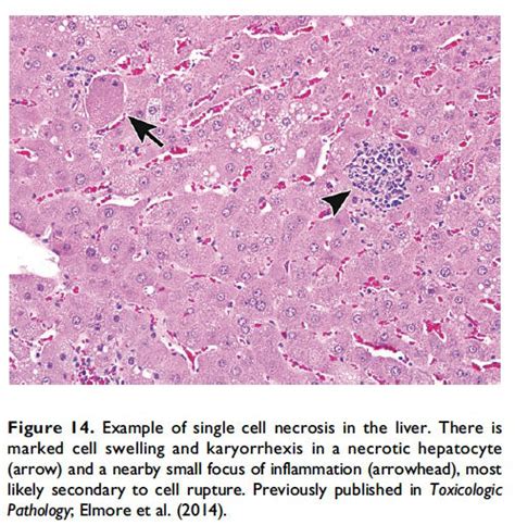 Caseous Necrosis Histology