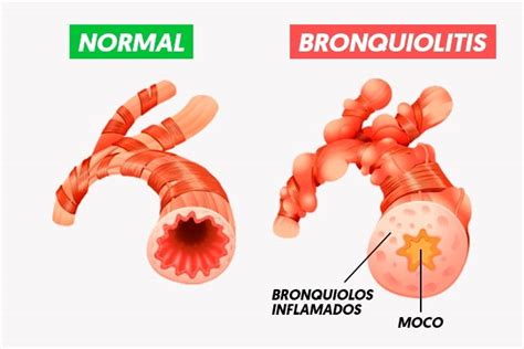 Bronquiolitis Qué Es Síntomas Y Tratamiento Tua Saúde