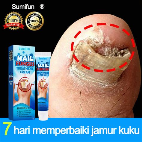 Jual Salep Jamur Kuku 20g Anti Obat Kuku Jamur Dan Rusak Terapi Jamur