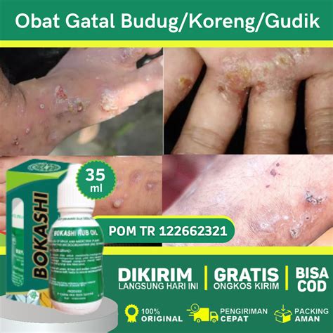 Obat Budug Di Kaki Obat Budug Anak Obat Gudik Obat Scabies Manusia