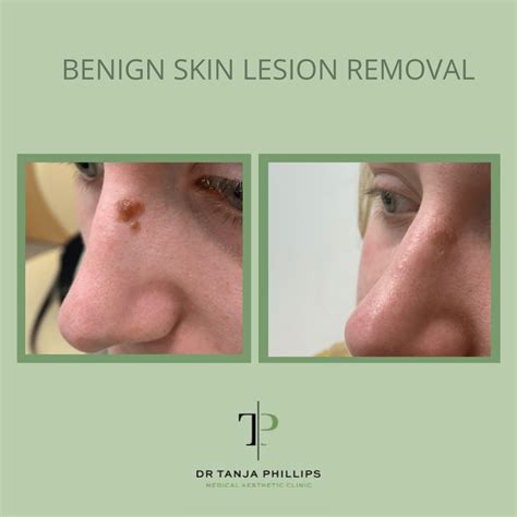 Treating Lumps Bumps And Benign Skin Lesions Dr Tanja Phillips Clinic