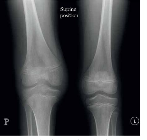 Juvenile Idiopathic Arthritis Xray