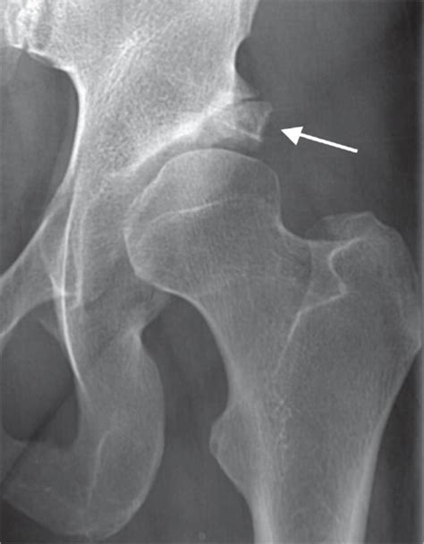 A Dysplastic Hip With Arrow Showing A Large Os Acetabu Open I