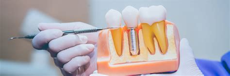 Proper Dental Implant Care Essential Aftercare Tips