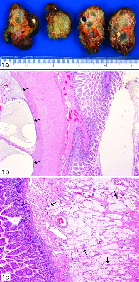 Pseudomyxoma Peritonei A Revisit Report Of 2 Cases And Literature