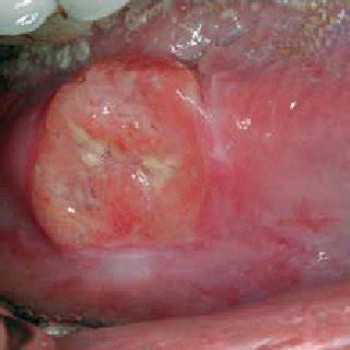 Known Cancer Patient Presenting With A Small Erosive Lesion On The Left