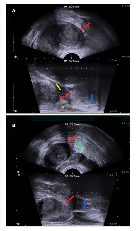 The Biplanar Transrectal Ultrasound Image A Perineal Nerve Block Download Scientific