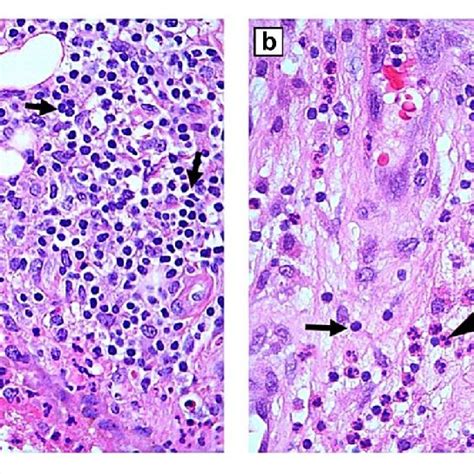 Hematoxylin And Eosin Slides Demonstrating Overlapping Features Of Download Scientific Diagram