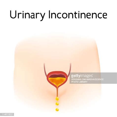 Urinary Incontinence Illustration Photos And Premium High Res Pictures