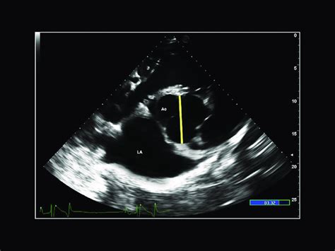 Echocardiographic Image Two Dimensional Echocardiographic Right