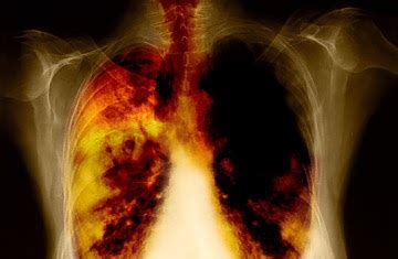 Lung Cancer Symptoms: Stage 4 lung cancer