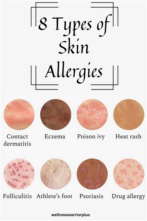 At Home Allergy Test 295 Triggers Types Of Skin Rashes Allergies