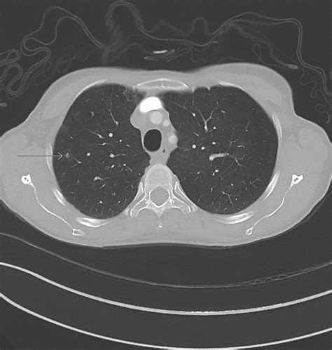 Pituitary Metastasis Image Radiopaedia Org