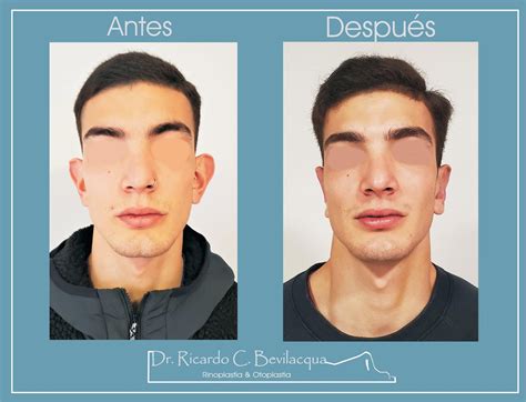 La Otoplastia Una Cirug A Con Resultados Sorprendentes Esteticas Ar