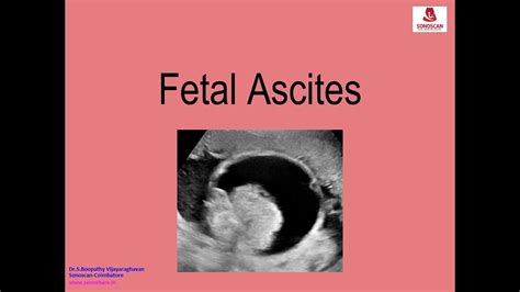 Sonography Of Fetal Ascites YouTube