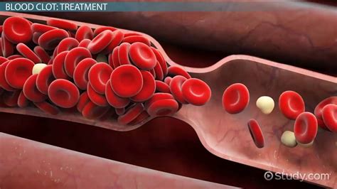 Blood Clot On Foot Treatment Discount | emergencydentistry.com