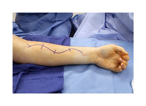 Median Fcr Fds To Radial Pin Ecrb Nerve Transfers With Pt To Ecrb Tendon Transfer Surgical