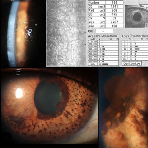 A Slit Lamp Biomicroscopy Imaging Of The Cornea Of This Patient