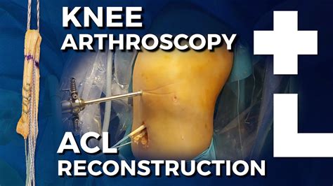 Knee Arthroscopy Acl Reconstruction Semitendinosus Graft Dworska