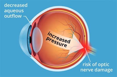 What To Know About Ocular Hypertension Cypress Eye Centre