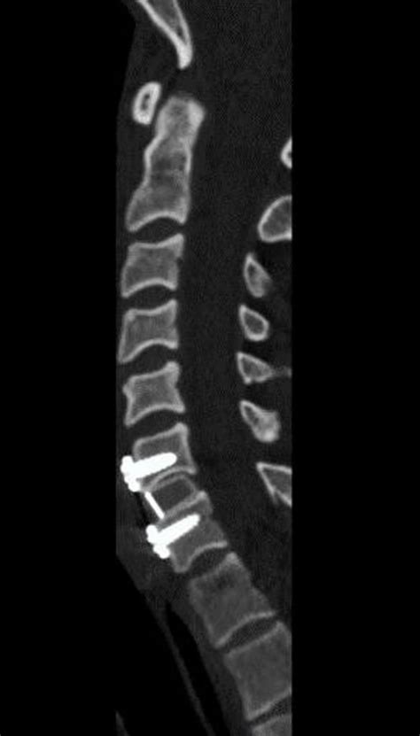 Manejo inicial y definitivo en paciente con fractura luxación subaxial