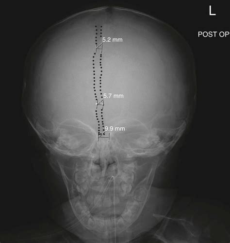 Metopic Craniosynostosis | Neupsy Key