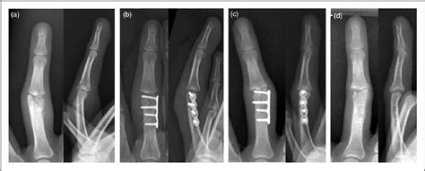 Figure 2 From Corrective Osteotomy For Distal Condylar Malunion Of The