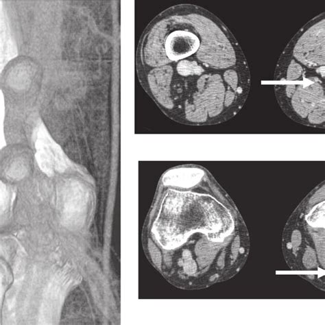 Postoperative Contrast Enhanced Computed Tomography Revealed