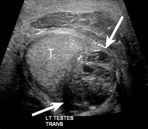 Figure 8 Scrotal Abscess Transverse Gray Scale Image Of The Left Hemiscrotum Shows A