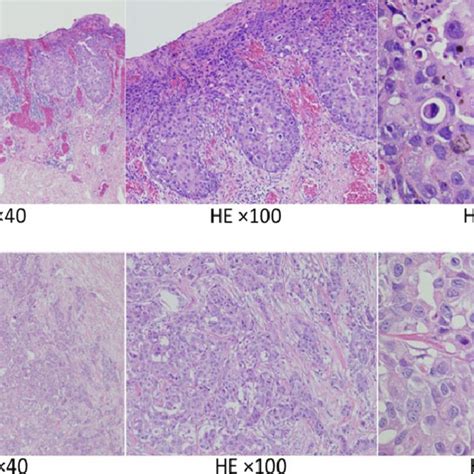 Hematoxylin And Eosin Staining Of Surgical Specimens A Specimens Of