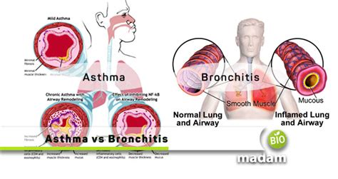 Difference Between Asthma And Bronchitis - biomadam