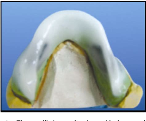 Figure 1 From Setting Up Of Teeth In The Neutral Zone And Its Effect On