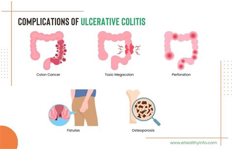 Ulcerative Colitis Symptoms Causes Treatment And More