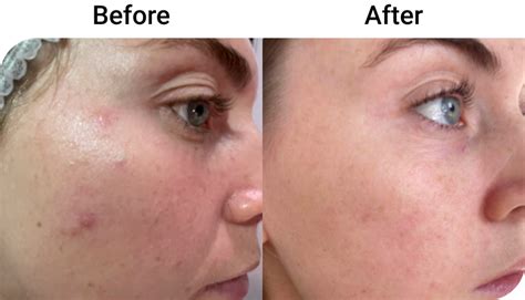 Gardenia Skin Co S Acne Treatment Before And After