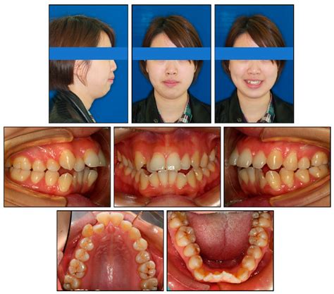 Figure 1 From Vertical Control Of A Severe Hyperdivergent Skeletal Class Ii Malocclusion With