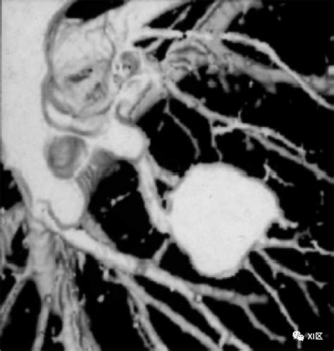 Ct近三十年发展史（上）：螺旋ct、多层ct、宽锥ct与双源ct Ct 图像 探测器 技术 扫描 健康界