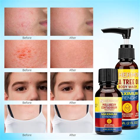 Buy Hermon Molluscum Contagiosum Kit Solution Tea Tree Oil Body Wash