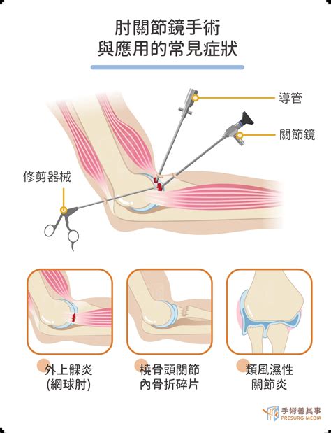 傷口小、術後恢復快 微創關節鏡手術正夯